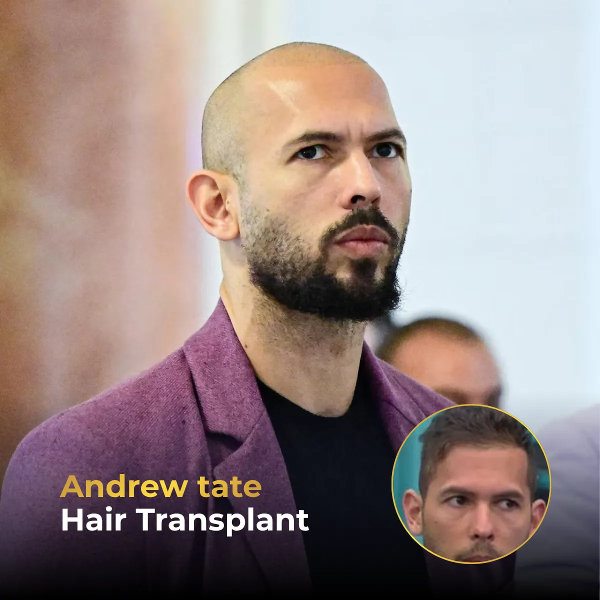 Andrew Tate hair transplant before after, Andrew Tate hairline analysis, Andrew Tate hair restoration, celebrity hair transplant, 4000 grafts, hair transplant rumors