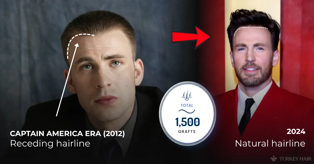 Chris Evans Captain America hairline, Chris Evans hairline transformation, Chris Evans natural hairline, Chris Evans hair transplant analysis, Chris Evans 1500 grafts, celebrity hair transplant comparison