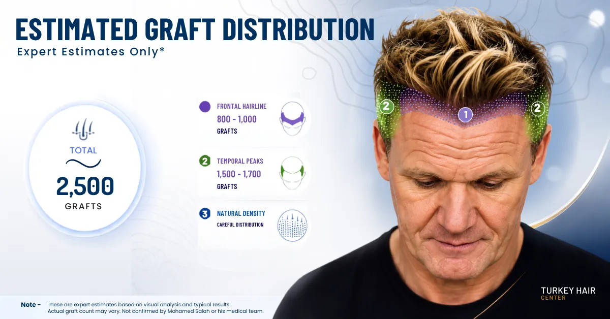 Gordon Ramsay estimated graft distribution for hairline restoration