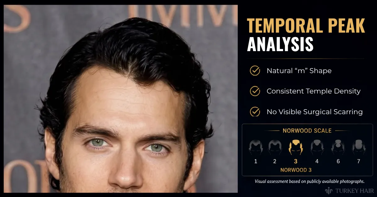Henry Cavill hairline, temporal peak, hair analysis, hair loss myths, celebrity hair