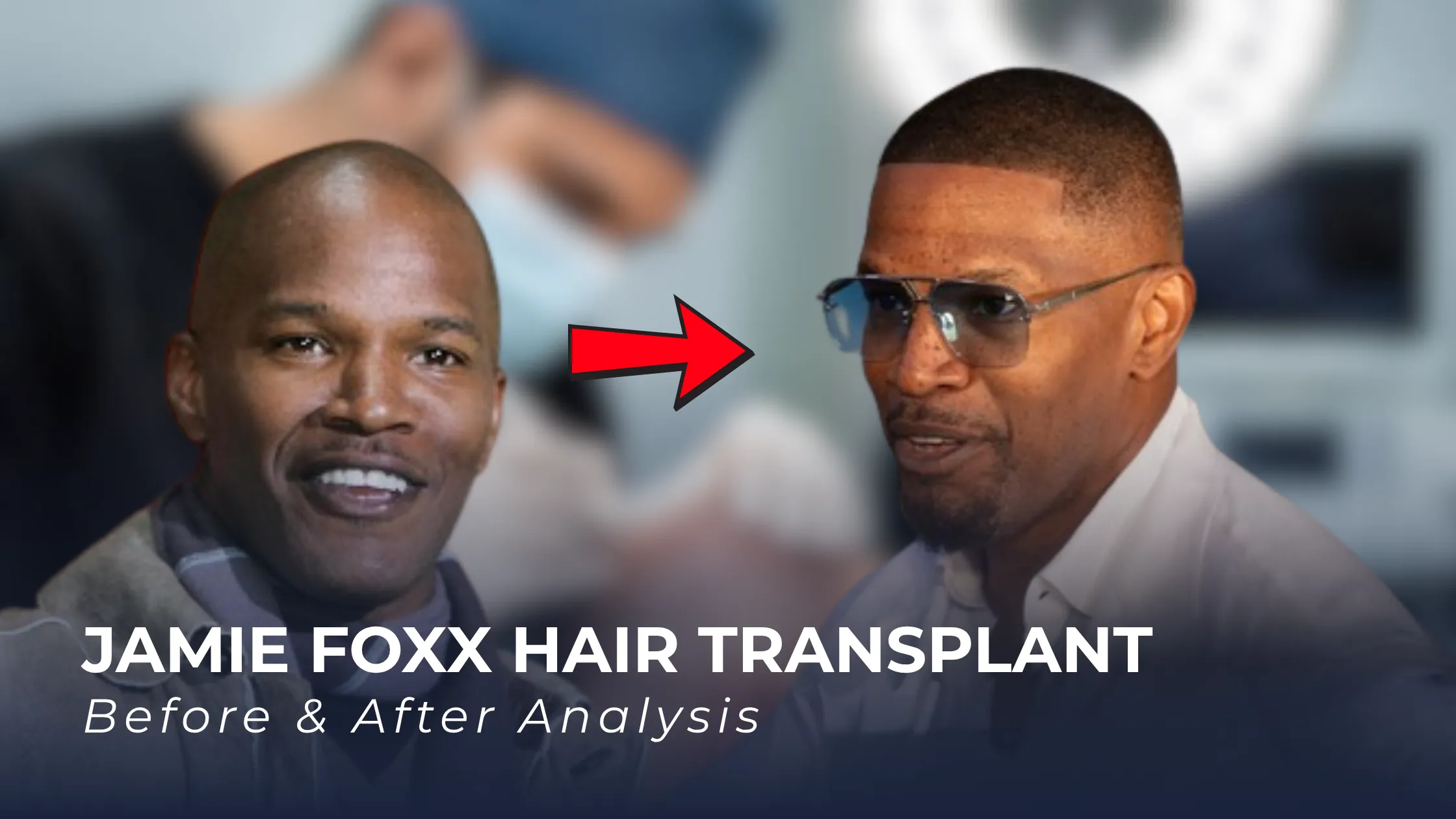 Jamie Foxx hairline analysis, Jamie Foxx hair transplant, celebrity hair restoration, hair transplant before after, hairline transformation, hair loss analysis
