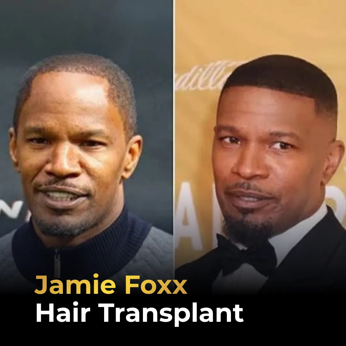 Jamie Foxx hairline analysis, Jamie Foxx hair transplant, celebrity hair restoration, hair transplant before after, hairline transformation, hair loss analysis