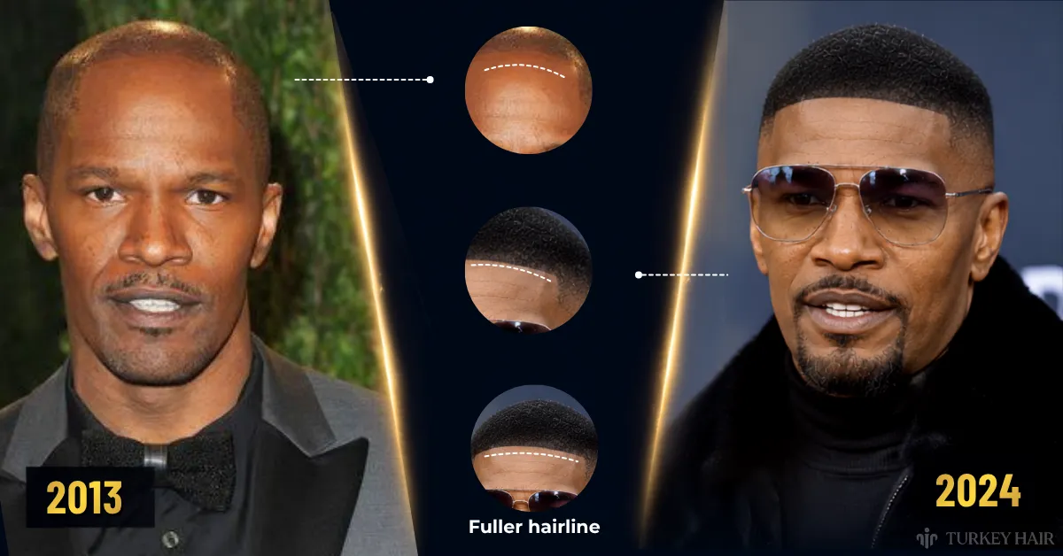 Jamie Foxx Hair Transplant: Head Tattoo, Hairline & Before-After Truth