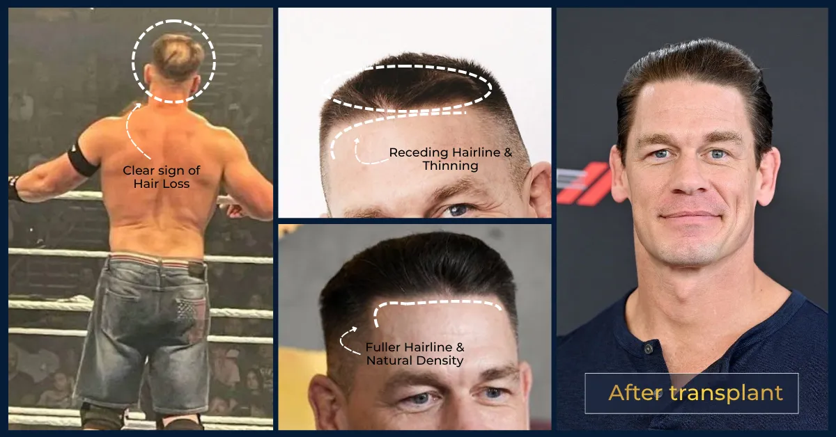 John Cena Hair Transplant: Confirmed Timeline, Before & After Photos, Crown Analysis