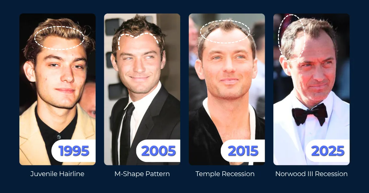 Jude Law, hair loss, timeline, receding hairline, celebrity, law