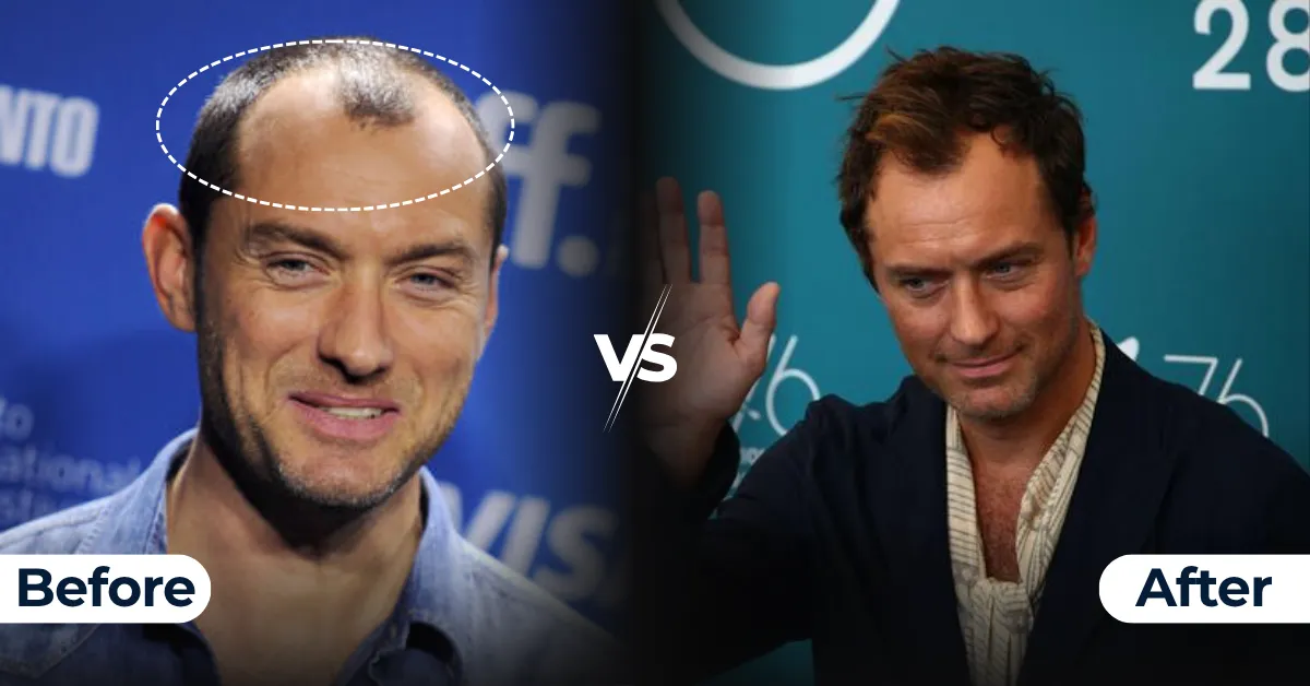 Jude Law, hair transplant, before after, celebrity, law, hair