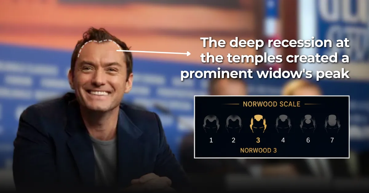 Jude Law, hair loss, Norwood scale, temple recession, hairline, law