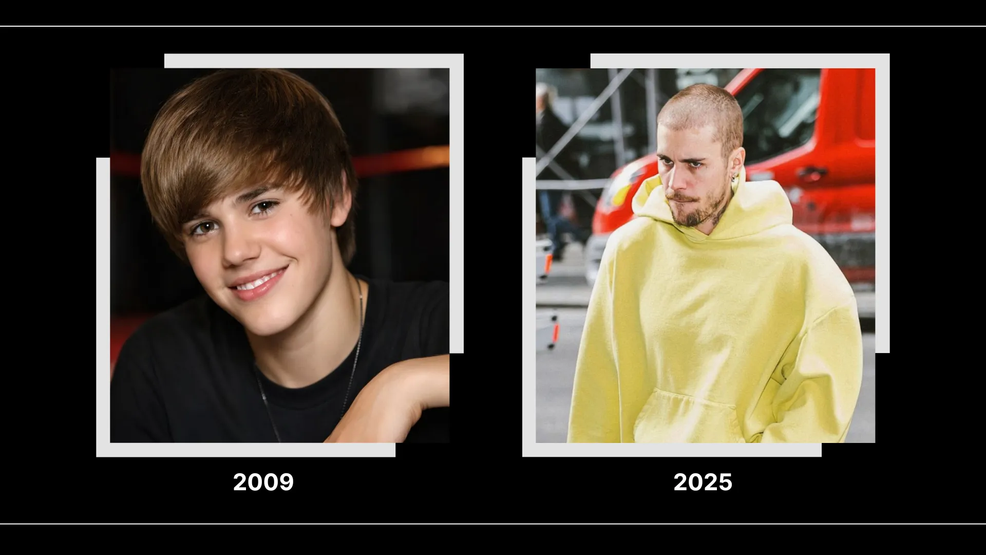 Justin Bieber Hair Transplant: Hairline Analysis, Before & After Photos, Rumors & Expert Opinion