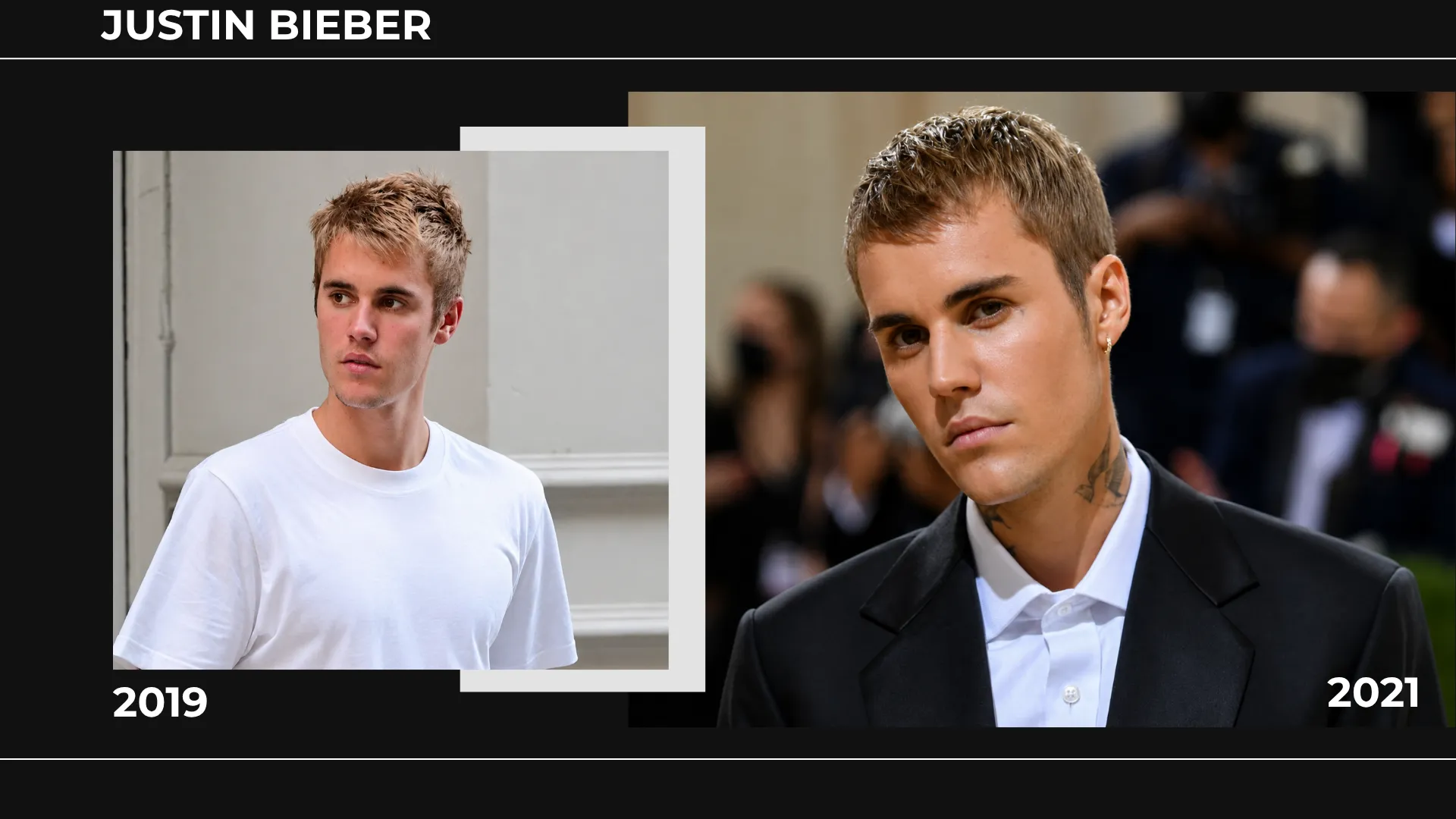 Justin Bieber Hair Transplant: Hairline Analysis, Before & After Photos, Rumors & Expert Opinion