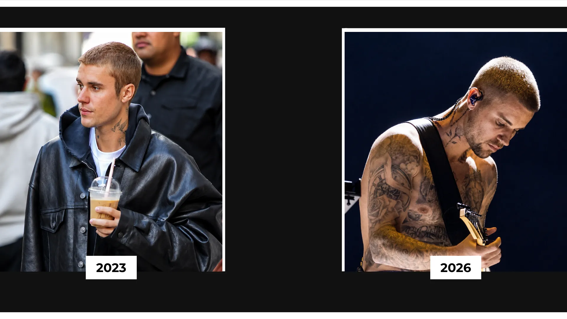 Justin Bieber Hair Transplant: Hairline Analysis, Before & After Photos, Rumors & Expert Opinion