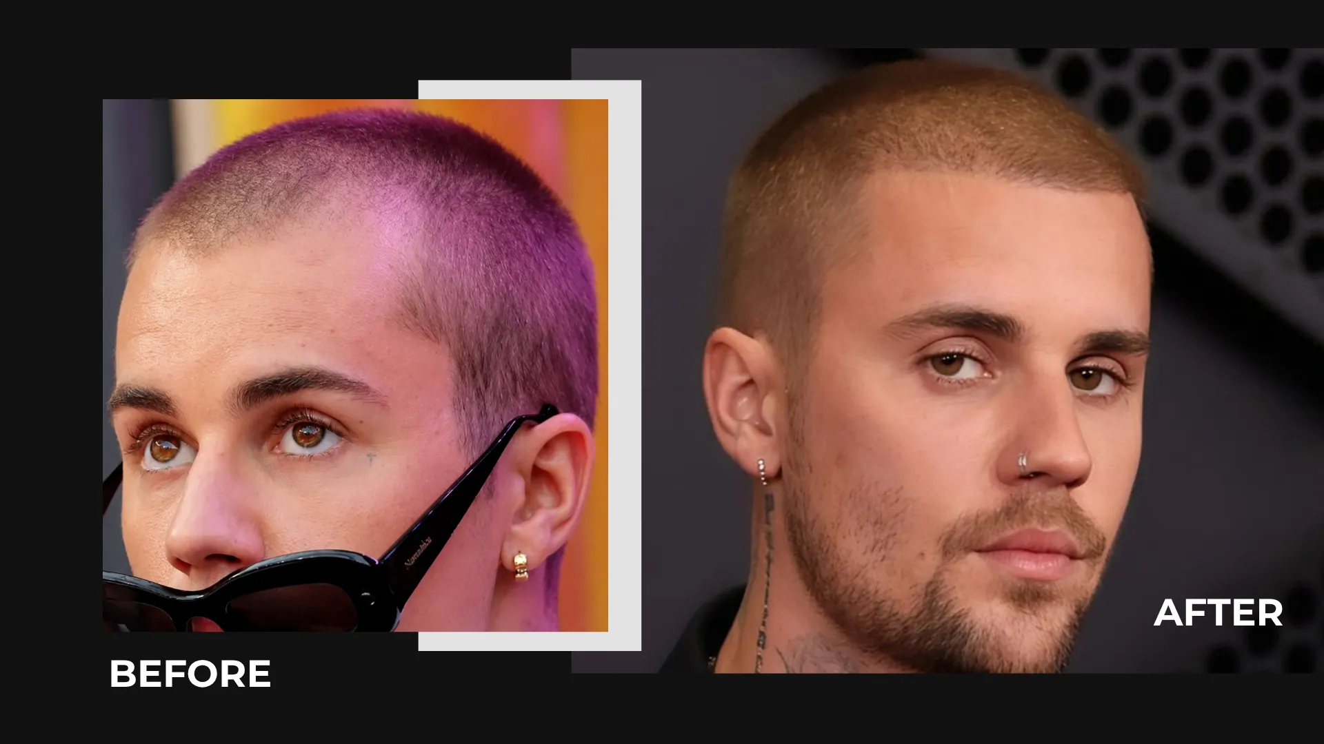 Justin Bieber Hair Transplant: Hairline Analysis, Before & After Photos, Rumors & Expert Opinion
