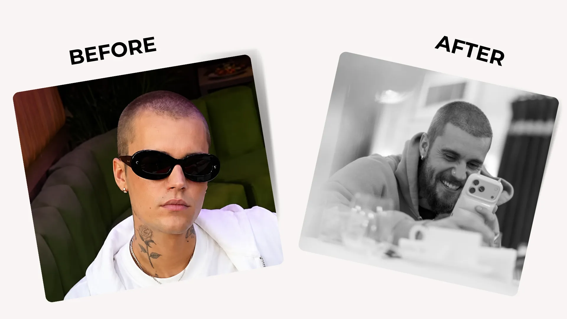 Justin Bieber Hair Transplant: Hairline Analysis, Before & After Photos, Rumors & Expert Opinion