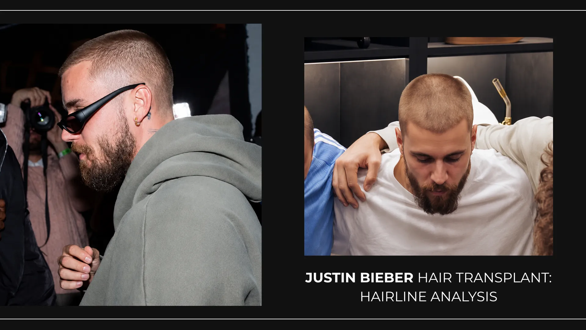 Justin Bieber Hair Transplant: Hairline Analysis, Before & After Photos, Rumors & Expert Opinion
