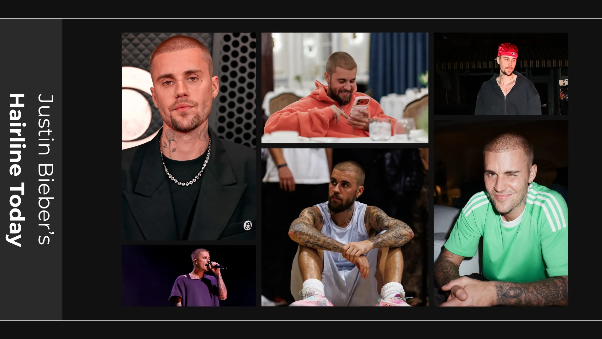 Justin Bieber Hair Transplant: Hairline Analysis, Before & After Photos, Rumors & Expert Opinion