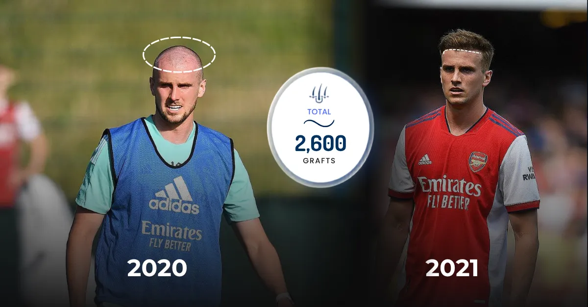 Rob Holding 2600 grafts, Rob Holding graft estimate, Rob Holding hair transplant grafts, Rob Holding hairline restoration, Rob Holding frontal density, footballer hair transplant analysis