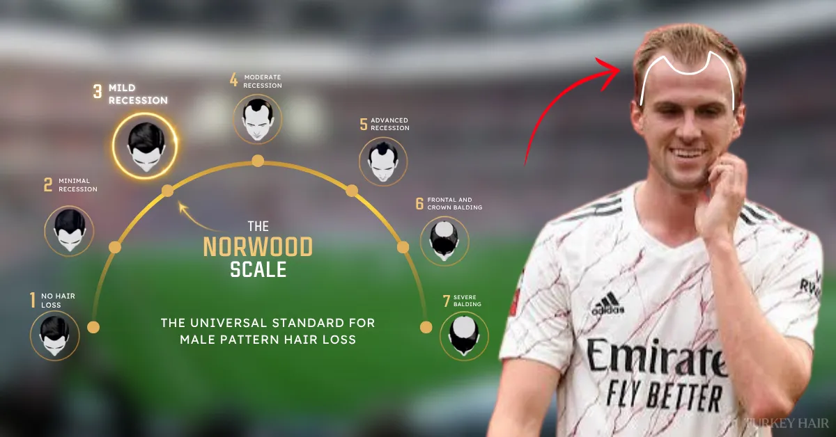 Rob Holding Norwood scale, Rob Holding hair loss stage, Rob Holding Norwood analysis, Rob Holding hairline recession, footballer hair loss, hair transplant graft estimate