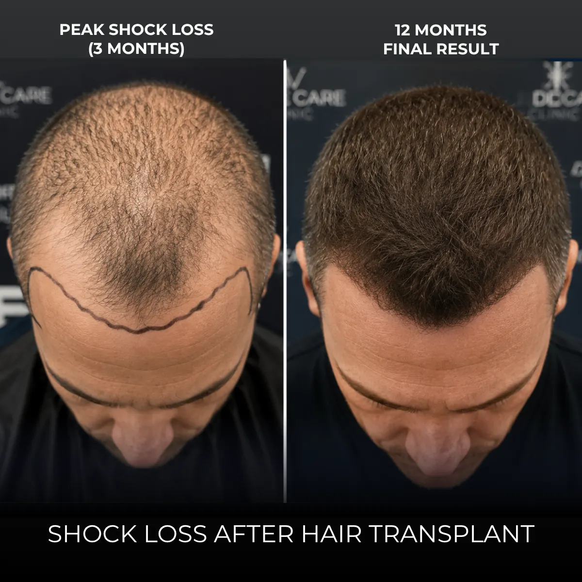 shock loss after hair transplant, complete recovery guide, hair shedding after transplant, hair transplant healing process, post op hair loss, shock loss treatment