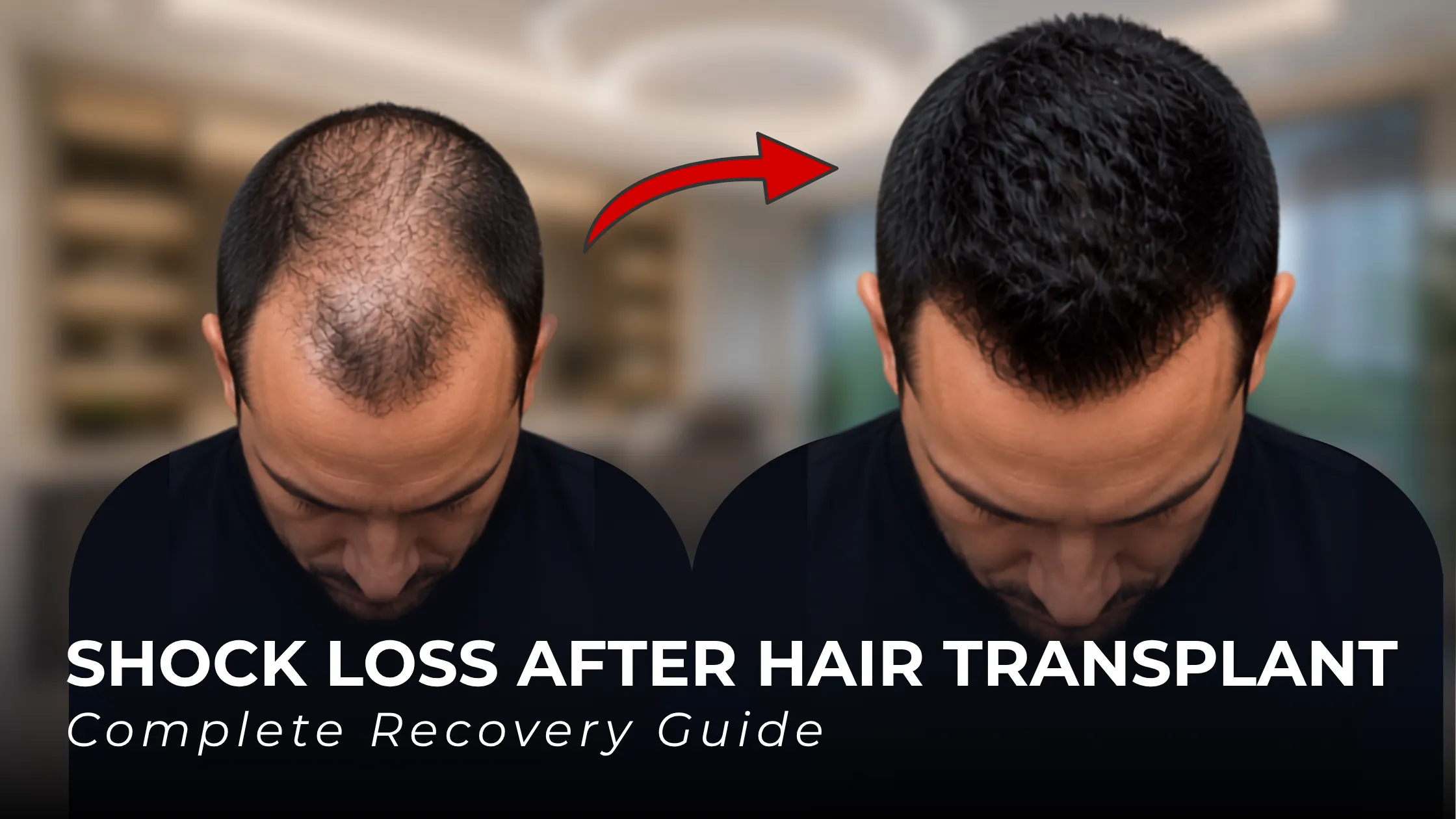 hair transplant recovery timeline, shock loss stage, hair growth after transplant, hair transplant month by month, post transplant recovery, final hair transplant results