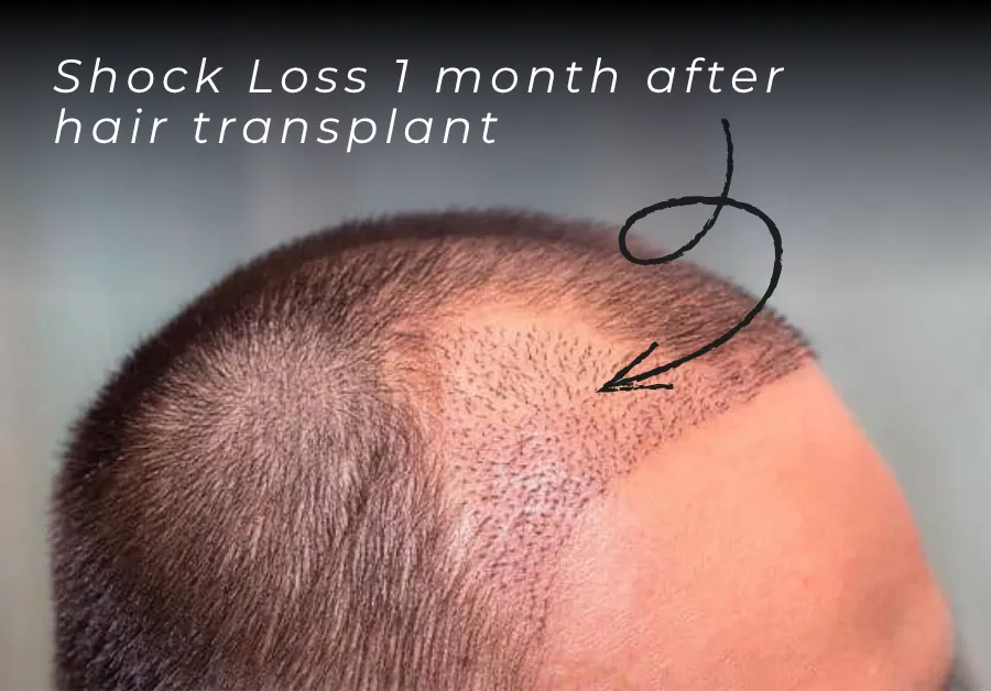 transplanted vs existing hair, shock loss analysis, native hair shedding, hair transplant recovery, graft survival after transplant, scalp shock after surgery